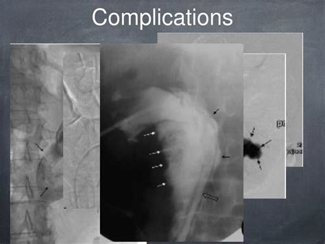 PPT - Nephrostomy PowerPoint Presentation, free download - ID:3591020