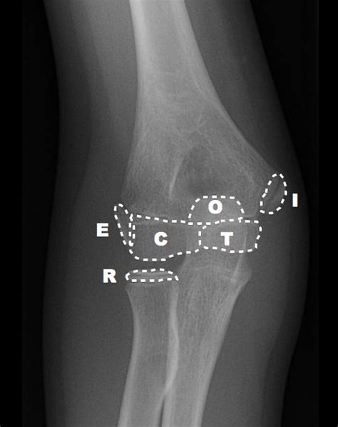 Paediatric Elbow Injuries - Emergency Medicine Kenya Foundation