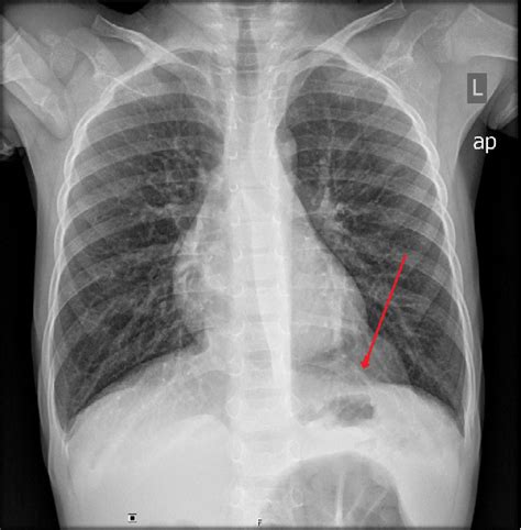 Figure 1 from Beaver tail liver on pediatric chest X-ray | Semantic Scholar