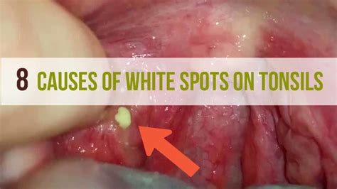 White Spots on Tonsils: Causes, Symptoms, Treatment, Risks