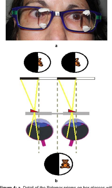 [PDF] Rehabilitation of Left Homonymous Hemianopia with Adjacent Palomar Prism Technique and ...