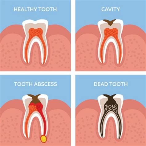 Tooth abscess symptoms: What is a dental abscess, how do you fix it? - GoHealthyGo