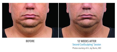 CoolSculpting Face / Neck Before and After Photos NYC