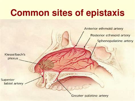 PPT - Epistaxis PowerPoint Presentation, free download - ID:1364903