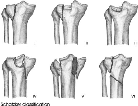 Classification systems for tibial plateau fractures; Does computed ...