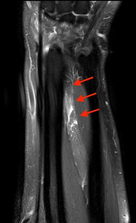 Extensor Pollicis Longus Rupture