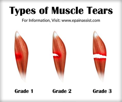 Muscle Tear|Types|Treatment|Recovery Period|Causes|Symptoms