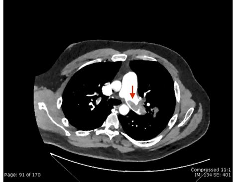 Saddle Pulmonary Embolus. CTA Annotated Red Arrow 1. JETem 2019 - JETem