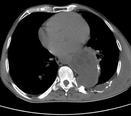 Extrapulmonary hydatid cyst | Radiology Case | Radiopaedia.org