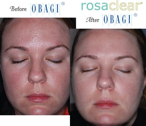 Obagi® Before and After Pictures – Micki Ly M.D. Maui Dermatologist