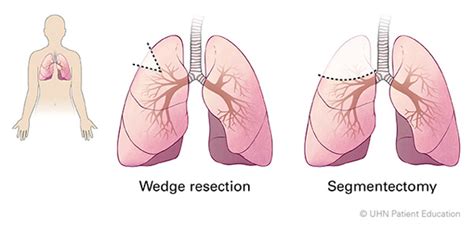 My Surgery: Wedge Resection