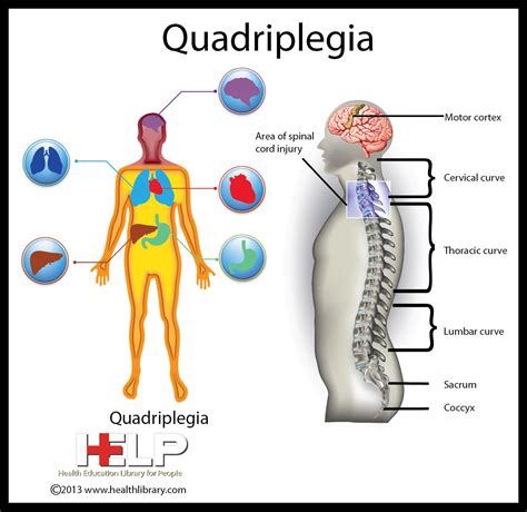 Quadriplegia