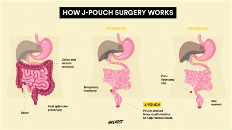 What Is J-Pouch Surgery? Procedure Stages