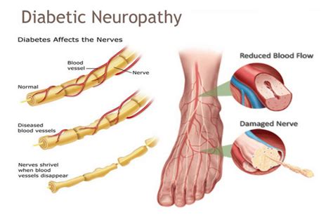 Diabetic Neuropathy - Center for Advanced Cardiac and Vascular Interventions