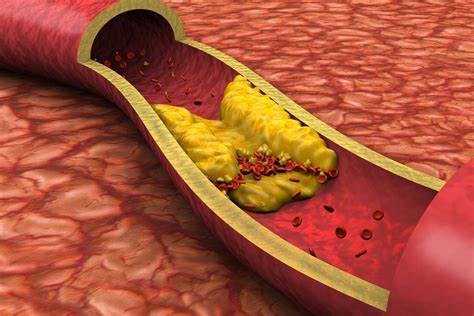 Should You Worry About Having High Cholesterol? Bon Cholesterol, High Cholesterol Levels, Lower ...