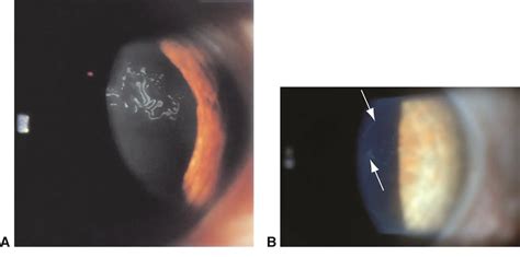 Epithelial basement membrane dystrophy - American Academy of Ophthalmology