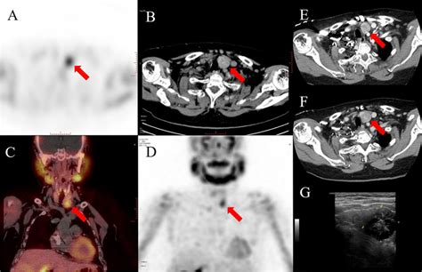 The 99mTc-MIBI SPECT/CT scan shows focused tracer accumulation with a... | Download Scientific ...