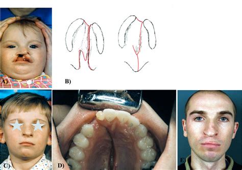 Long-term Observations and Own Concepts in Cleft Lip and Palate Repair