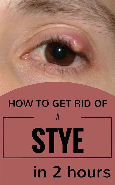 Anyone confronted with a stye, at least once in his life. It’s a painful and not a very pleasant ...