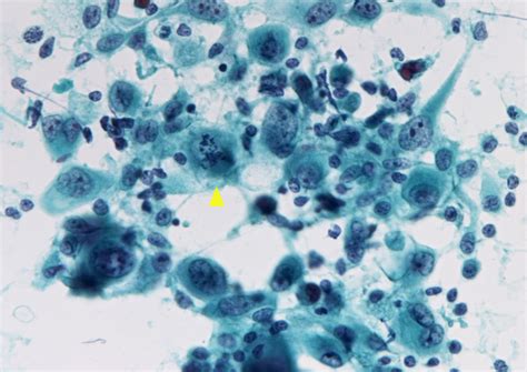 Anaplastic Thyroid Cancer Cytology - CancerWalls