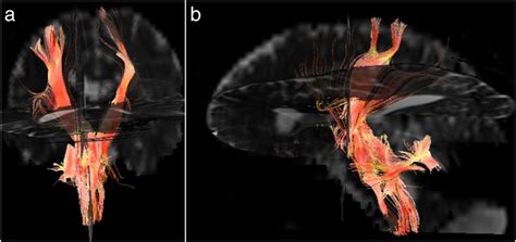 Diffusion tensor imaging was performed. A fractional anisotropy map was ...