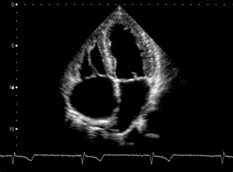 Smaller Ventricular Size May Be Associated With More Severe Asthma - Pulmonology Advisor