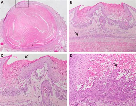 Histopathology. (A) Infundibular cyst underneath a focal area of... | Download Scientific Diagram