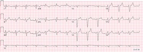 Dr. Smith's ECG Blog: Sinus rhythm with a new wide complex QRS