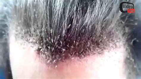 DISGUSTING MASSIVE HAIR LICE INFESTATION - YouTube