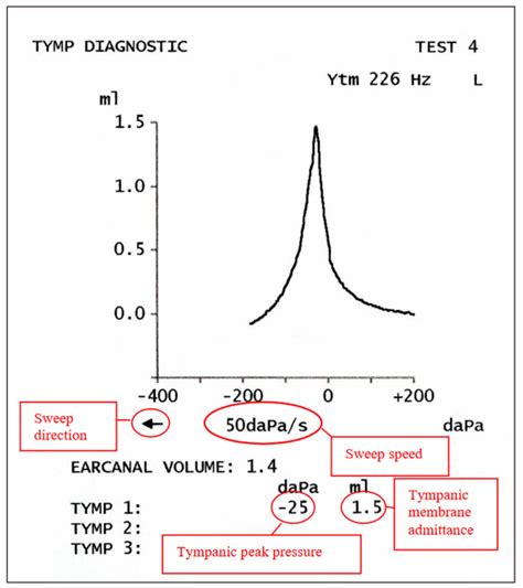 Tympanometry test, tympanometry types & abnormal tympanometry results