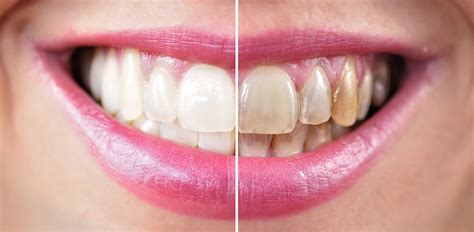 Teeth Whitening NYC | Professional Zoom Whitening