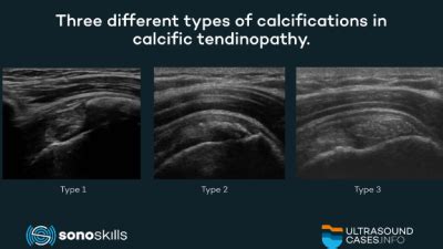 Calcific tendinopathy: a summary from recent literature / SonoSkills