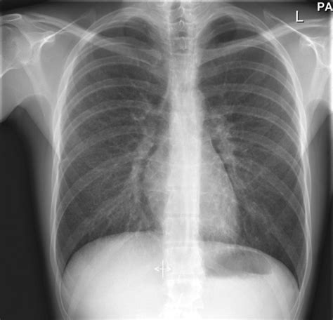 Chest X Ray Infiltrates