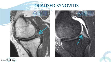 SYNOVITIS MRI FINDINGS KNEE WHAT DOES IT LOOK LIKE - Radedasia