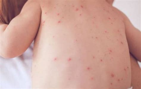 10 Signs and Symptoms of Measles You Need to Know