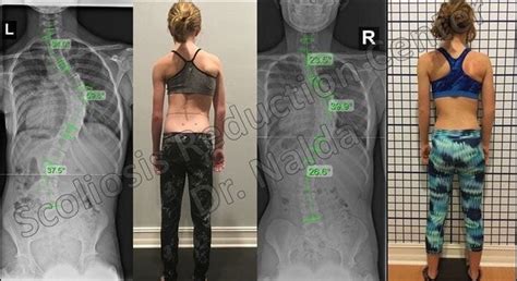 Scoliosis Before And After