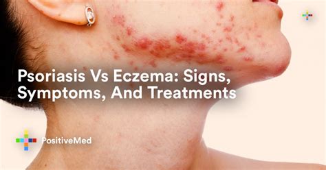 Psoriasis Vs Eczema: Signs, Symptoms, And Treatments - PositiveMed