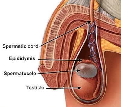 Epididymal Cyst - Nick Brook Urology Adelaide