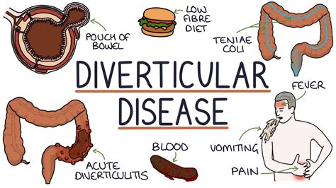 Diverticulitis: Symptoms, Treatment Options, and Diagnosis | September 2023