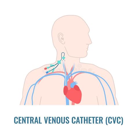 Central Line Catheter Stock Illustrations – 51 Central Line Catheter Stock Illustrations ...