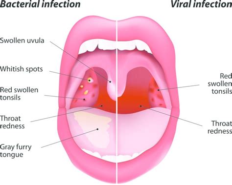 Sore Throat: Symptoms, Causes, Treatment, and Diagnosis | FindATopDoc