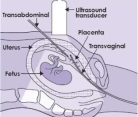 Chorionic Villi Ultrasound