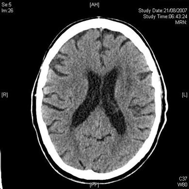 Hypertensive Encephalopathy – RCEMLearning India