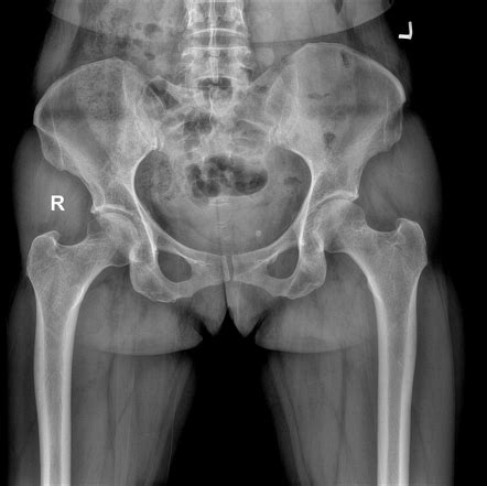 Synovial herniation pit | Radiology Case | Radiopaedia.org