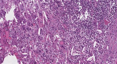 Cholesteatoma Eyelid