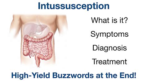 Intussusception: Pronunciation, Symptoms, Ultrasound, Treatment ...