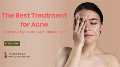 Microneedling for Acne Scar Management by skination Clinic - Issuu