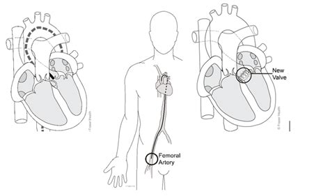 Transcatheter aortic valve implantation (TAVI) - Fraser Health Authority