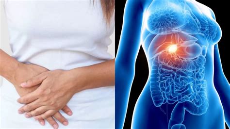 Cáncer de Vesícula: síntomas, diagnóstico y opciones de tratamiento ...