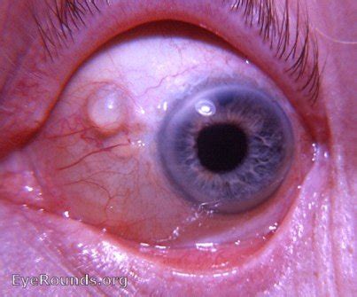 Conjunctival implantation cyst following cataract surgery. EyeRounds.org: Online Ophthalmic Atlas